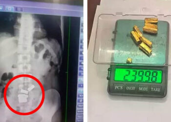 Young man eats gold I সাত টুকুৰা সোণ খাইছিল এজন যুৱকে, অস্ত্ৰোপচাৰ নকৰাকৈ উলিয়ালে চিকিৎসকে