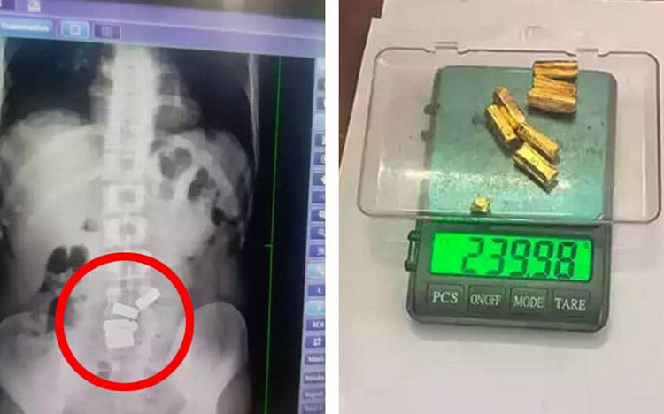 Young man eats gold I সাত টুকুৰা সোণ খাইছিল এজন যুৱকে, অস্ত্ৰোপচাৰ নকৰাকৈ উলিয়ালে চিকিৎসকে