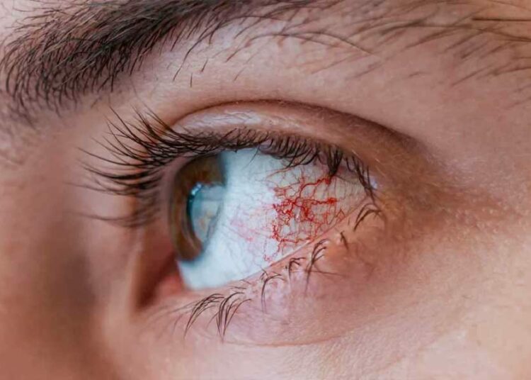Monsoon Conjunctivitis Outbreak I চকুৰ সংক্ৰমণৰ বাবে ২৯ জুলাইলৈকে বন্ধ অৰুণাচলৰ সকলো বিদ্যালয়