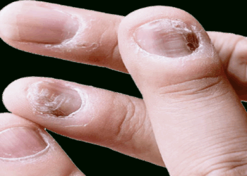 Nails problem in Maharashtra । চুলি সৰাৰ পিছত এইবাৰ নষ্ট হৈছে নখ, ৰহস্যময় কাৰণত মহাৰাষ্ট্ৰৰ বহু গাঁৱত আতঙ্ক