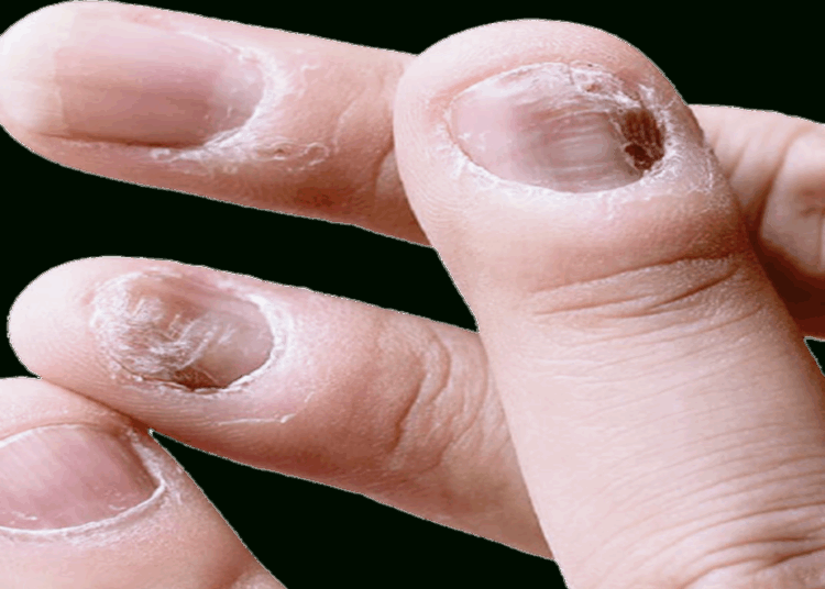 Nails problem in Maharashtra । চুলি সৰাৰ পিছত এইবাৰ নষ্ট হৈছে নখ, ৰহস্যময় কাৰণত মহাৰাষ্ট্ৰৰ বহু গাঁৱত আতঙ্ক
